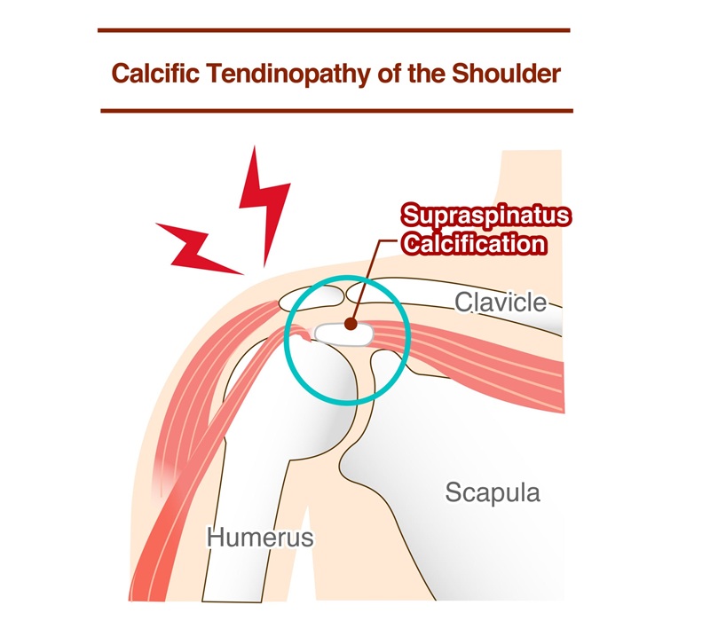 Medical diagram illustrating calcific tendinopathy and supraspinatus tendon calcium deposit in the shoulder