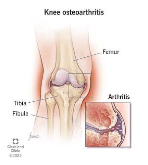 Degeneration of knee cartilage and joint space narrowing in osteoarthritis