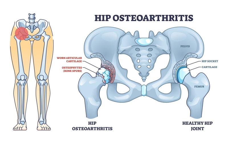 Healthy hip joint vs. osteoarthritic cartilage breakdown.