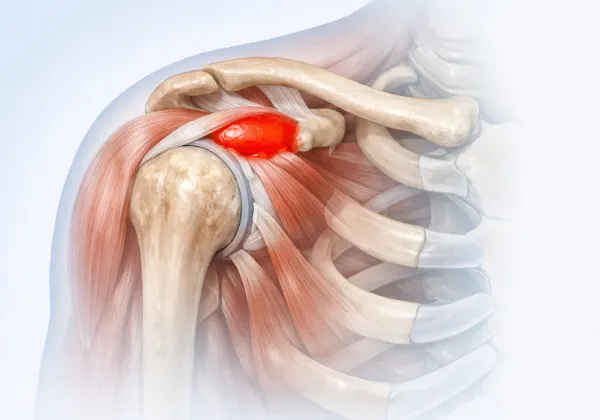 shoulder bursitis natural treatment