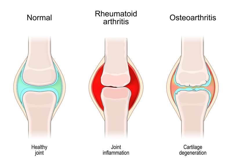Comparative pathology of healthy vs. arthritic joints