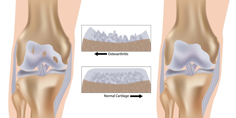 Osteoarthritis breakdown vs. healthy cartilage lining.