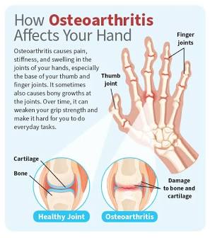 Structural cartilage wear in hand osteoarthritis