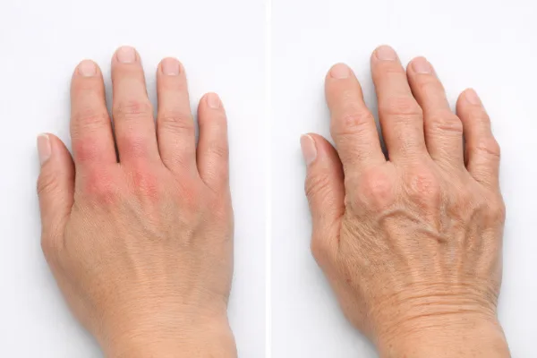 lupus joint pain vs arthritis